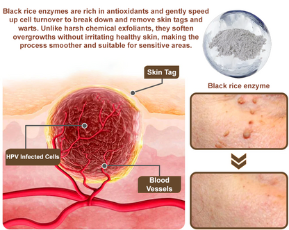 Pureluxo®Black Rice Skin Repair Essence Cream — FDA-Certified Skin Growth & Damage Treatment (For warts, seborrheic keratosis, skin tags, keratin buildup, hyperpigmentation, age spots, hyperplasia, etc.)