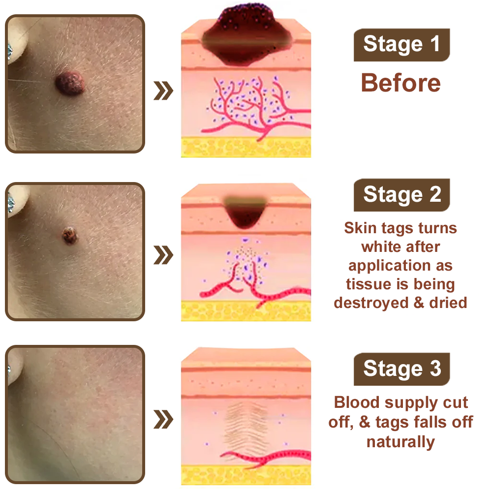 Pureluxo®Black Rice Skin Repair Essence Cream — FDA-Certified Skin Growth & Damage Treatment (For warts, seborrheic keratosis, skin tags, keratin buildup, hyperpigmentation, age spots, hyperplasia, etc.)