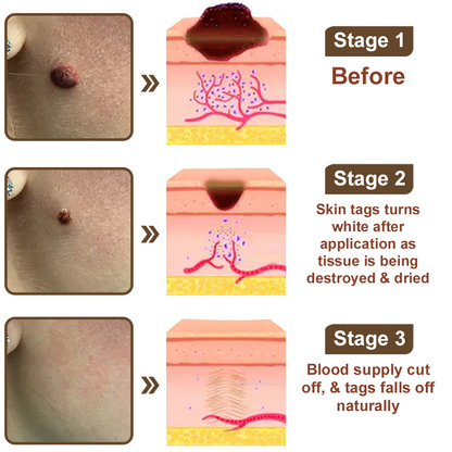 Pureluxo®Black Rice Skin Repair Essence Cream — FDA-Certified Skin Growth & Damage Treatment (For warts, seborrheic keratosis, skin tags, keratin buildup, hyperpigmentation, age spots, hyperplasia, etc.)