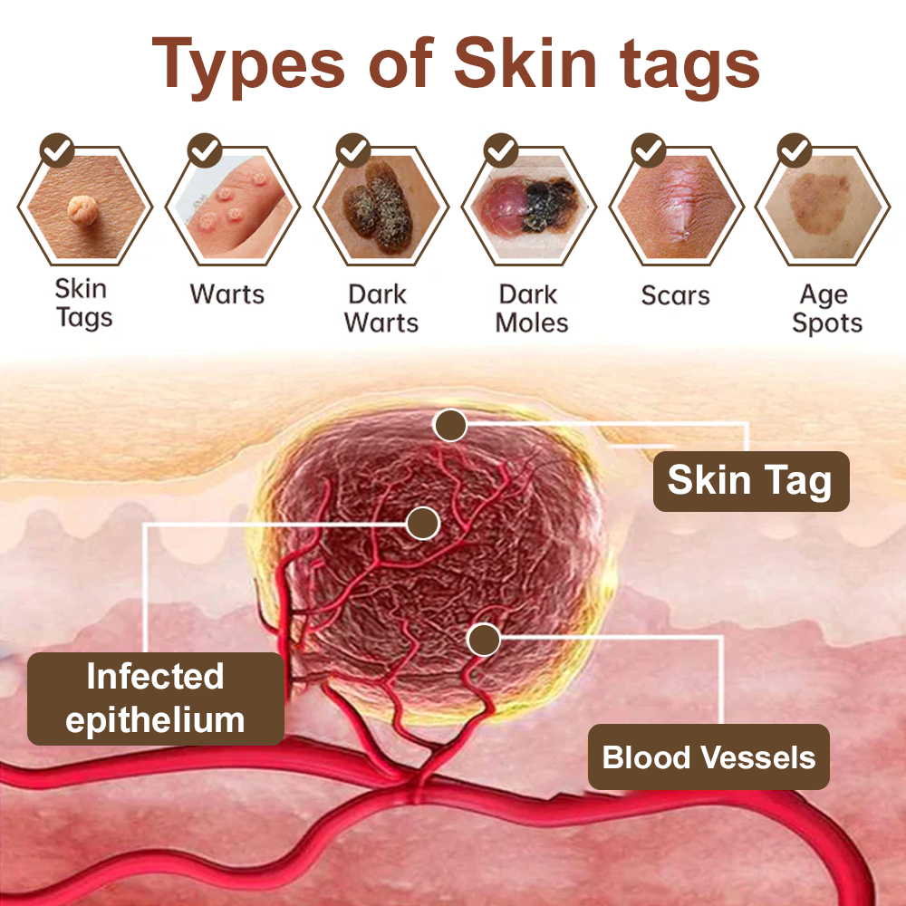 Pureluxo®Black Rice Skin Repair Essence Cream — FDA-Certified Skin Growth & Damage Treatment (For warts, seborrheic keratosis, skin tags, keratin buildup, hyperpigmentation, age spots, hyperplasia, etc.)