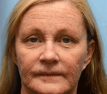 (Made and Shipped from USA) 🧑‍⚕️TLOPA® Botox Bee Venom Wrinkle Removal Cream- LAST DAY 70% OFF🧑‍⚕️